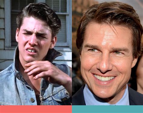 Tom Cruise Before and After Braces