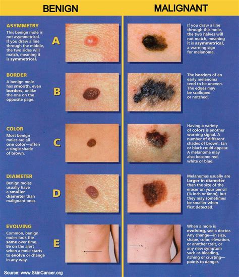 Dr. Visha Blog: The ABCDE of Melanoma