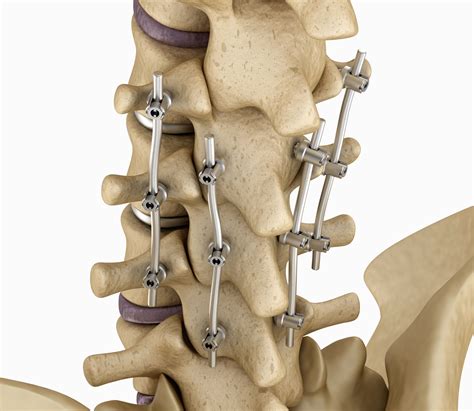 Spinal Fusion – Cedar Park, TX – Austin, TX - Spine Stabilization