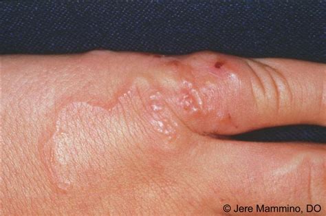 Cutaneous Larva Migrans - American Osteopathic College of Dermatology (AOCD)