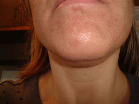 how do i get rid of these bumps on my chin!!? - Adult acne - Acne.org