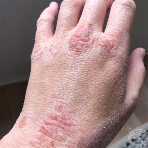 This Woman's Severe Eczema Has People Worried She's Contagious - But It's The Fault Of Her ...