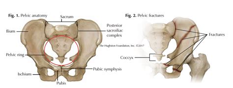 Pelvic Fractures - Hughston Clinic