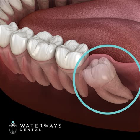 What To know About Wisdom Teeth Removal | Waterways Dental