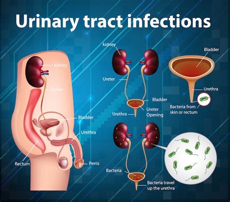 Premium Vector | Informative illustration of urinary tract infections