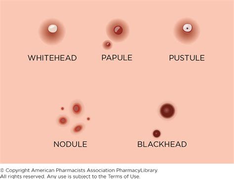 Types of Acne | PharmacyLibrary