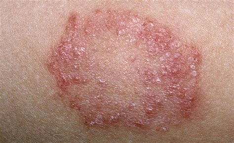 Skin Fungal Infection Pictures / Fungal Infection: Definition, Symptoms, Causes ... : Fungal ...