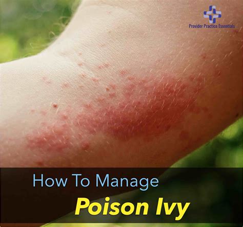 Poison Ivy Rash Showing Up Days Later - Infoupdate.org