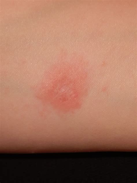 Red Itchy Bumps On Skin Causes Symptoms Pictures Treatment – NBKomputer