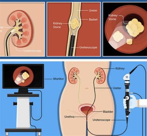 Natural Treatment for Kidney Stones