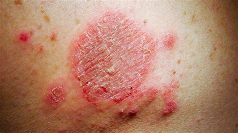 Itchy Spots On Skin Treatment | MedicineNet 2021