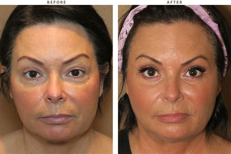 Mid Face Lift – Before and After Pictures * | Dr Turowski - Plastic Surgery Chicago