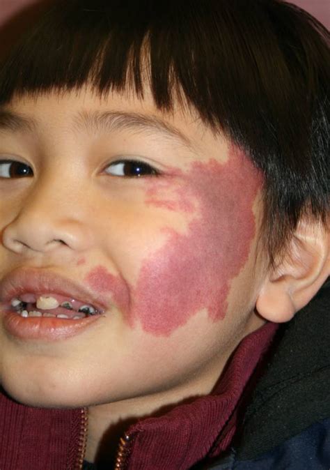 Port Wine Stains and Sturge Weber Syndrome | New York, NY