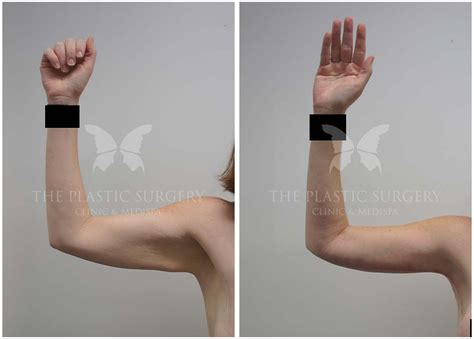 Arm Lift Gallery | Before and Afters | Dr Chaithan Reddy