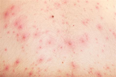 Chicken Pox Symptoms In Adults Pictures - Mahilanya