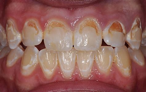 Temporary Tooth Filling Front Teeth : Dental Photos Before After Photos Evanston Dentist, During ...