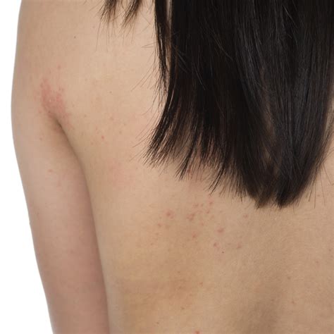 Are Red Spots on the Skin a Gluten Allergy? | Healthfully