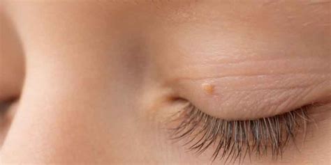 Lump On Eyelid Treatment