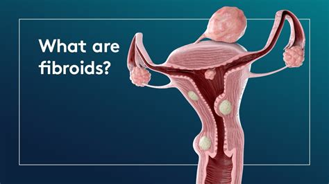 What is a Fibroid? - YouTube