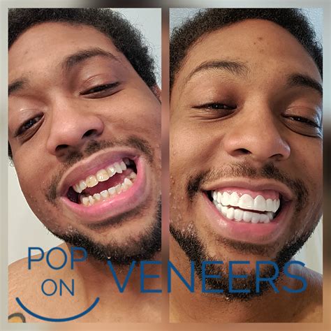 Gonna be spicy – Pop on Veneers