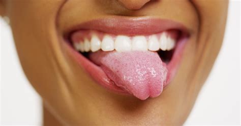 5 Common Tongue Problems