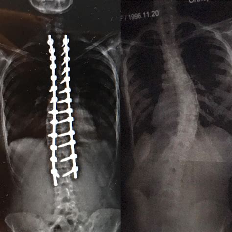 Before and after of the surgery I had in May 2018 : r/scoliosis