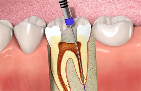 Root Canal Treatment | Oralux Dental