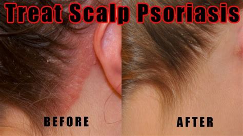 Psoriasis Scalp Treatment