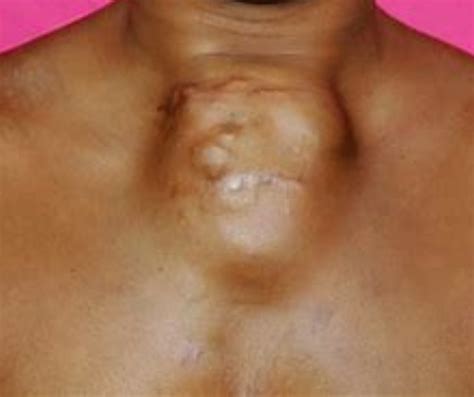 Sternum Cancer : Causes, Symptoms, Diagnosis, And Treatment