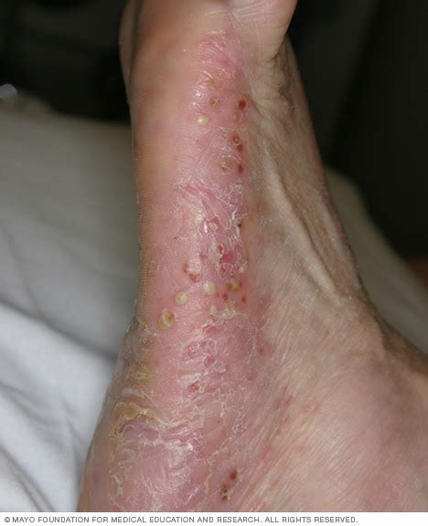 Psoriasis - Symptoms and causes - Mayo Clinic