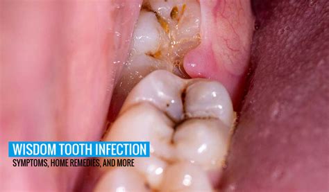 Wisdom Tooth Infection: Symptoms, Home Remedies, and More