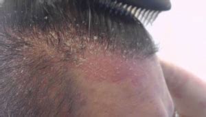 How to Treat Psoriasis and Dry Scalp with Shampoo – Paul M. Barrett