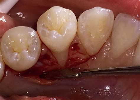 Initial incisions at the mucogingival junction of #21 with partial... | Download Scientific Diagram