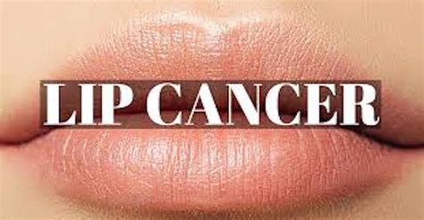 Lip Cancer Treatment Guidelines | Sitelip.org