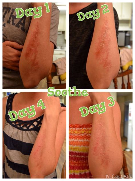 I used Soothe to help with a really bad case of poison ivy! It was at the tale end where I ...