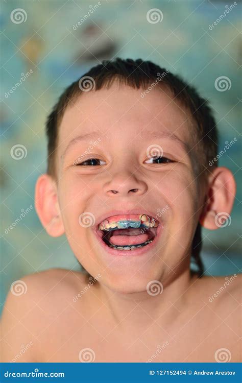 A child with braces smiles stock photo. Image of smile - 127152494