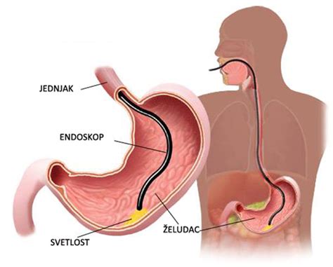 Upper GI Endoscopy