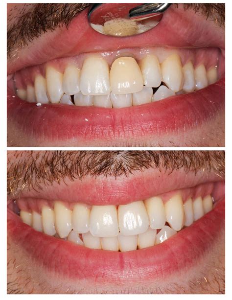 Teeth Veneers Before And After