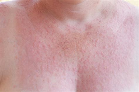 Sun poisoning: Here's what you need to know