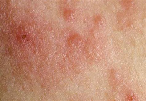 Itchy Armpit Rash Hiv Home | Images and Photos finder