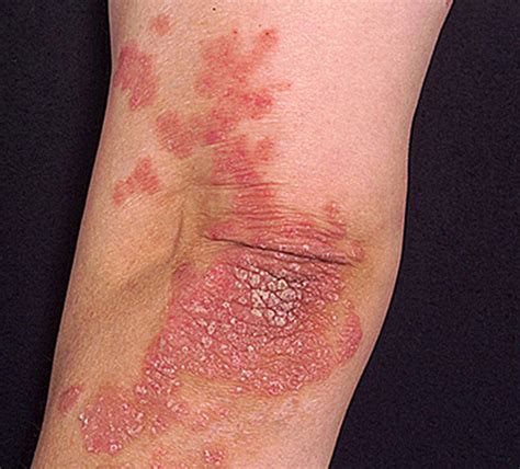 Psoriasis - Appearance, Causes, Types, Symptoms, Treatment, and Diet