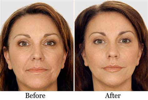 Liquid Facelift San Francisco | Non Surgical Facelift