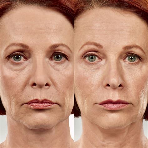 Botox For Smokers Lines Before And After