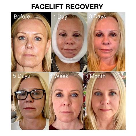 Facelift Recovery | Facelift recovery, Facelift, Face lift surgery