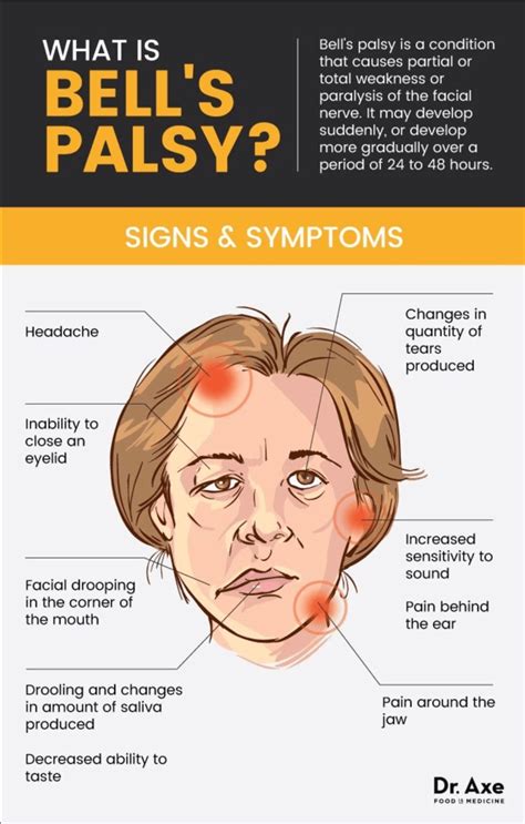 Bells Palsy Facial Nerve Bells Palsy Medical Knowledge | The Best Porn ...