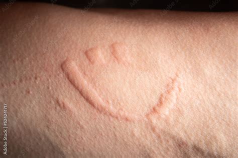 Smiling face hives. Hives spread when you scratch on the skin. Stock Photo | Adobe Stock