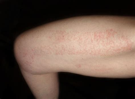 Red Spots on Skin: Causes, Diagnosis, and Treatments