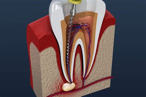 Root canal treatment process. 3D illustration | Hancock Village Dental | Dentist Clermont Florida