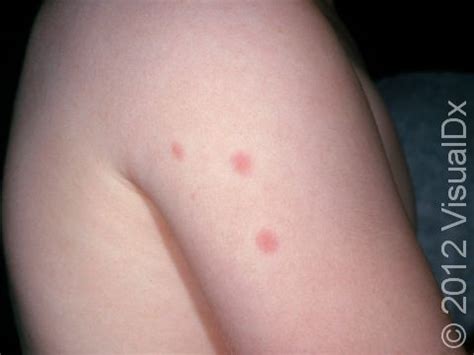 Bed Bug Bites Pictures, Symptoms: What Do Bed Bug Bites Look Like ...