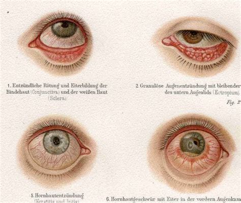 Sclera Eye Diseases - Celera Anda